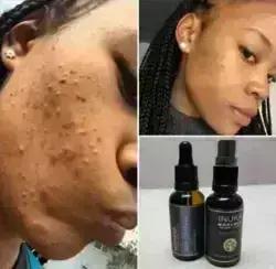 Mohlolo oil and skin clearing oil