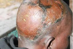 Head Tumor Man Confirms He Was Not Cured At Magaya's PHD