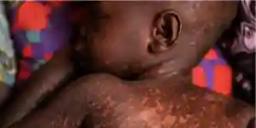 WHO Raises Concern After Measles Kills 704 Children In Zimbabwe